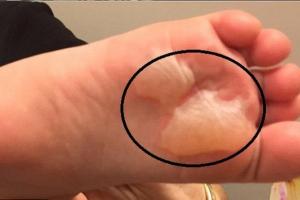 Cách chữa phồng rộp da chân khi đi bộ nhiều, mang giày chật
