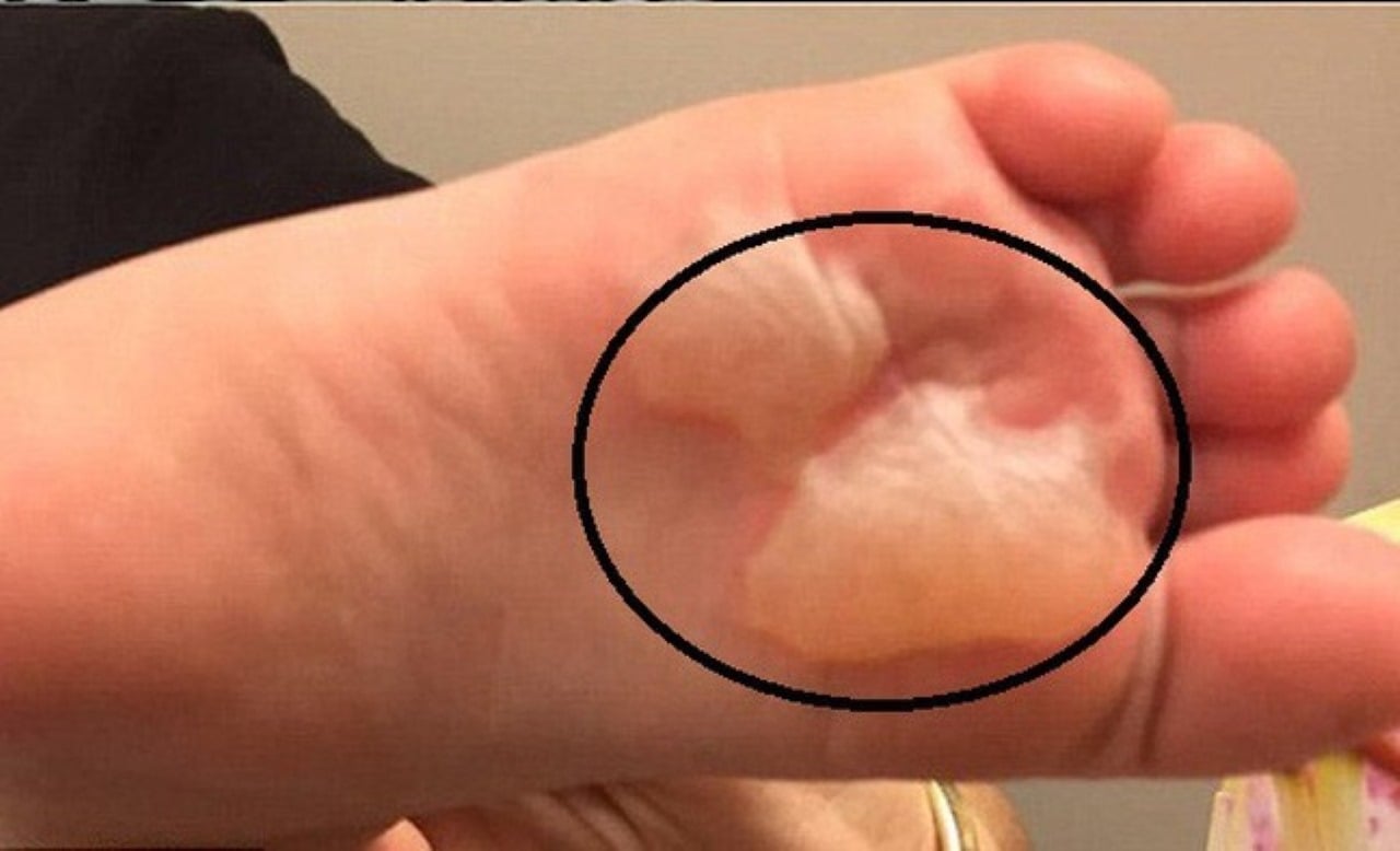 Cách chữa phồng rộp da chân khi đi bộ nhiều, mang giày chật